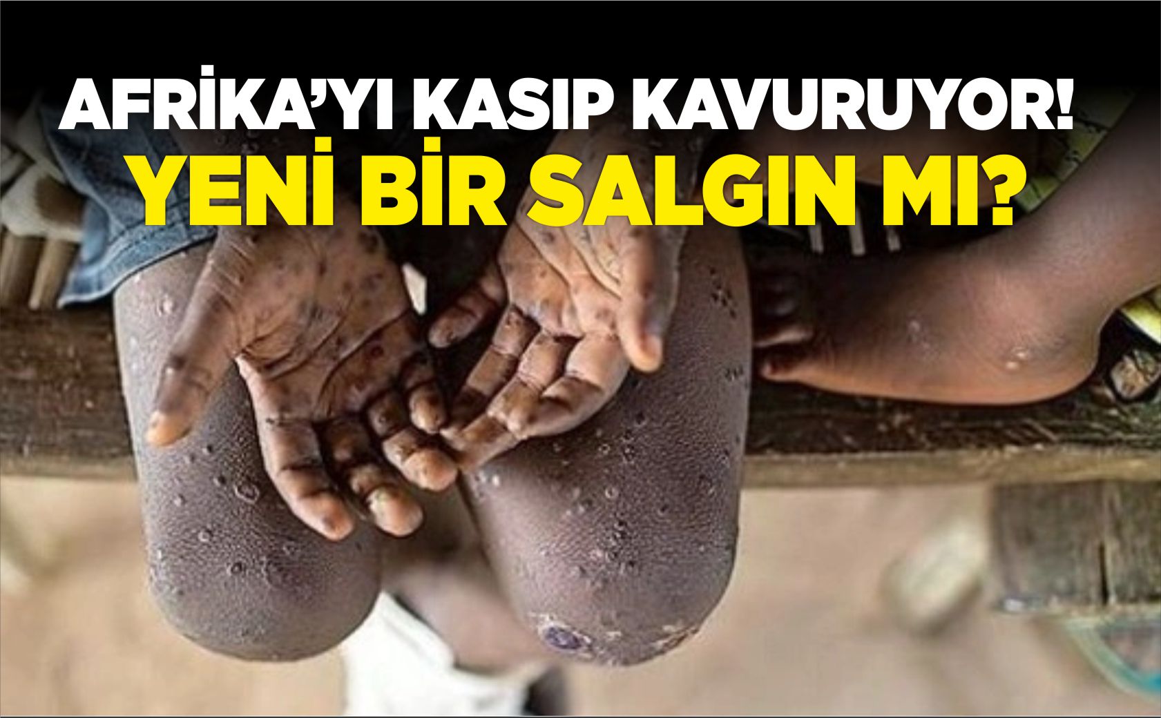 afrika-m-çiçeği-salgını